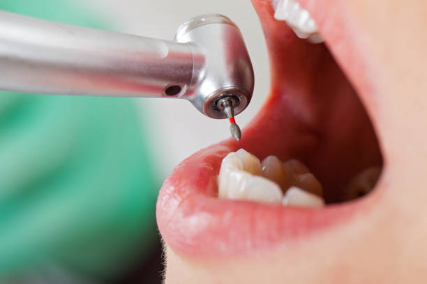 Best Chipped Tooth Repair Near Me  in Morrisonville, NY